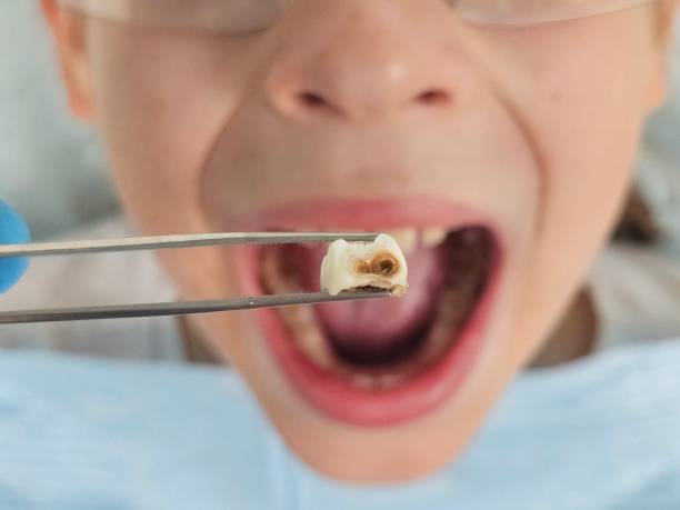 Best Dentist for Tooth Abscess  in Morristown, NJ